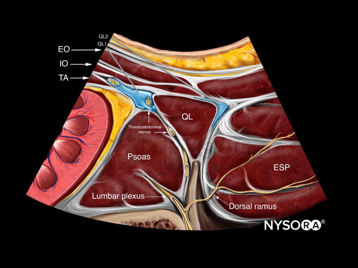 QLB vs Morphine intrathécale post césarienne