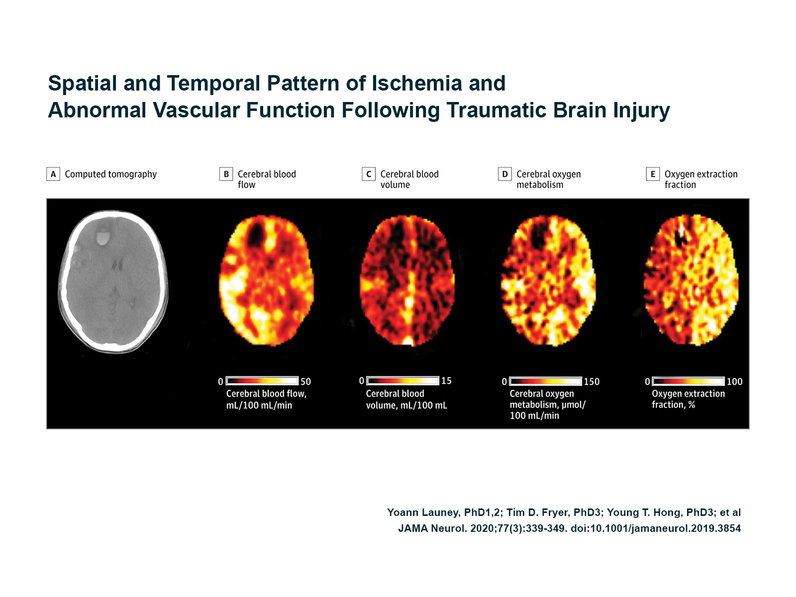 Launey JAMA Neurology 2020